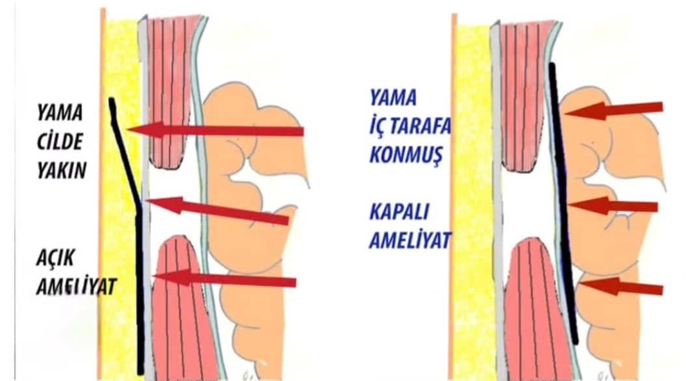 Sağlıkta yatırımlar sonuç veriyor: Ardahan’da kapalı kasık fıtığı ameliyatı başarıyla yapıldı